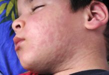 Kopřivka u dětí se projeví svědivými červenými pupeny. Léčba se odvíjí od věku dítěte kopřivka