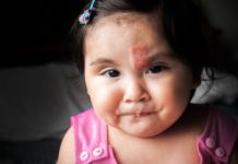 Hemangiom je běžným nezhoubným nádorem kojenců. Kdy je potřeba zahájit léčbu? Hemangiom