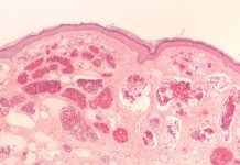 Hemangiom je běžným nezhoubným nádorem kojenců. Kdy je potřeba zahájit léčbu? Hemangiom