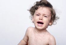 Zarděnky způsobují rozvoj charakteristické vyrážky. Kdy se proti této nemoci očkuje? Zarděnky