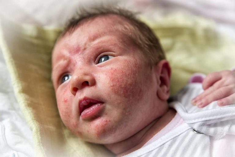 Novorozenecké akné se může objevit kolem 3. týdne života. Jak ho poznat?
