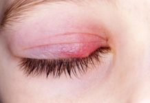 Ječné zrno u dětí vyléčíte doma, vlčí zrno vyžaduje návštěvu lékaře. Jak se od sebe liší? jecne_zrno_v_oku