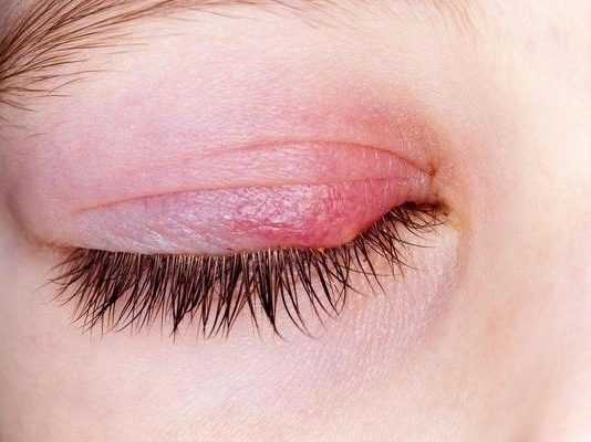 Ječné zrno u dětí vyléčíte doma, vlčí zrno vyžaduje návštěvu lékaře. Jak se od sebe liší? jecne_zrno_v_oku